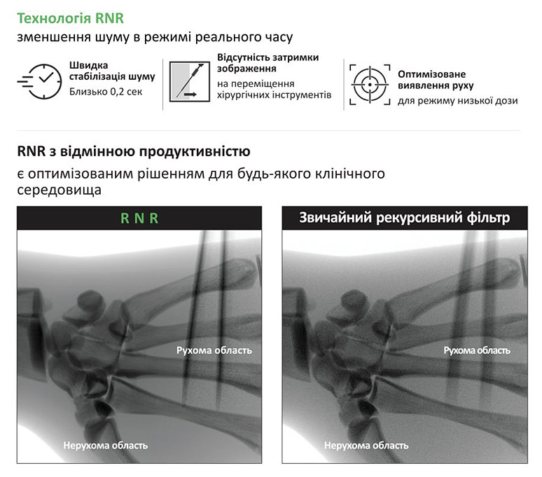 Рентгеновская система флюороскопическая EXTRON 7, DRTECH - Технология RNR (уменьшение шума в режиме реального времени)