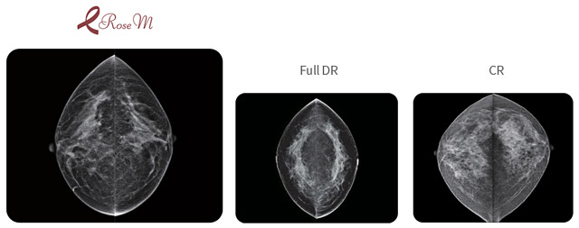 Цифрова мамографія - рішення для оновлення аналогових мамографів.