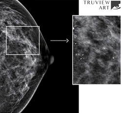 Цифрова мамографія - Система обробки зображень TRUVIEW ART.