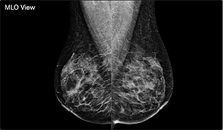 Цифрова мамографія - рішення для оновлення аналогових мамографів. Цифрові детектори RSM 2430C та RSM 1824C, (RoseM) - DRTECH