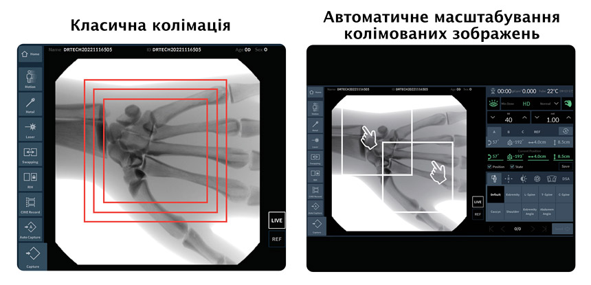 Система рентгенівська флюороскопічна EXTRON 7, DRTECH - Автоматична колімація