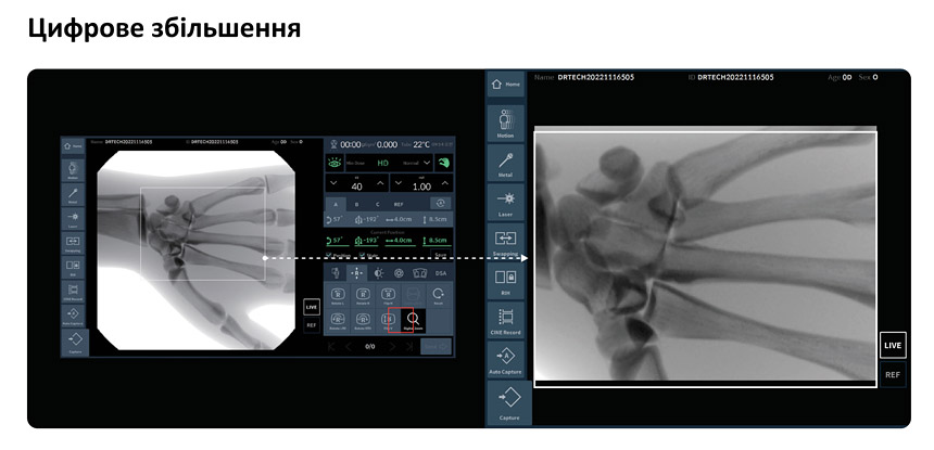 Система рентгенівська флюороскопічна EXTRON 7, DRTECH - Цифрове збільшення